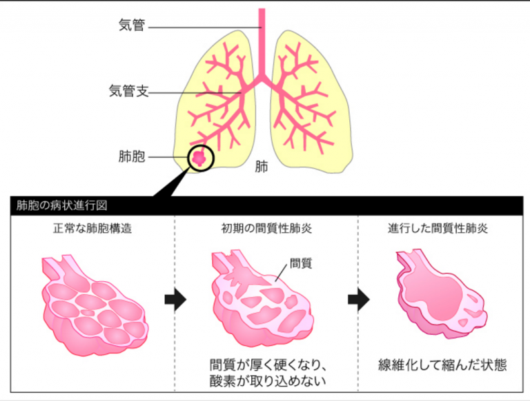 拘束性換気障害と閉塞性換気障害の違い | ゴローの解剖生理学勉強法